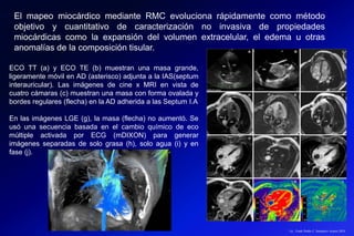 Lic.: Frank Patiño C. Seminario Azuero 2018
El mapeo miocárdico mediante RMC evoluciona rápidamente como método
objetivo y cuantitativo de caracterización no invasiva de propiedades
miocárdicas como la expansión del volumen extracelular, el edema u otras
anomalías de la composición tisular.
ECO TT (a) y ECO TE (b) muestran una masa grande,
ligeramente móvil en AD (asterisco) adjunta a la IAS(septum
interauricular). Las imágenes de cine x MRI en vista de
cuatro cámaras (c) muestran una masa con forma ovalada y
bordes regulares (flecha) en la AD adherida a las Septum I.A
En las imágenes LGE (g), la masa (flecha) no aumentó. Se
usó una secuencia basada en el cambio químico de eco
múltiple activada por ECG (mDIXON) para generar
imágenes separadas de solo grasa (h), solo agua (i) y en
fase (j).
 