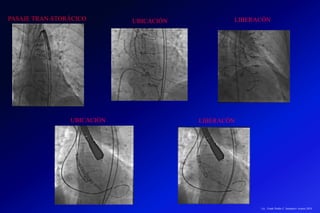 UBICACIÓN
LIBERACÓN
UBICACIÓN
LIBERACÓN
PASAJE TRAN-STORÁCICO
Lic.: Frank Patiño C. Seminario Azuero 2018
 