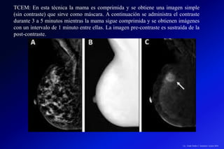 TCEM: En esta técnica la mama es comprimida y se obtiene una imagen simple
(sin contraste) que sirve como máscara. A continuación se administra el contraste
durante 3 a 5 minutos mientras la mama sigue comprimida y se obtienen imágenes
con un intervalo de 1 minuto entre ellas. La imagen pre-contraste es sustraída de la
post-contraste.
Lic.: Frank Patiño C. Seminario Azuero 2018
 