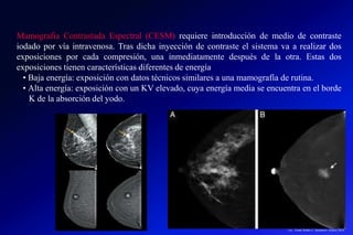 Mamografia Contrastada Espectral (CESM) requiere introducción de medio de contraste
iodado por vía intravenosa. Tras dicha inyección de contraste el sistema va a realizar dos
exposiciones por cada compresión, una inmediatamente después de la otra. Estas dos
exposiciones tienen características diferentes de energía
• Baja energía: exposición con datos técnicos similares a una mamografía de rutina.
• Alta energía: exposición con un KV elevado, cuya energía media se encuentra en el borde
K de la absorción del yodo.
Lic.: Frank Patiño C. Seminario Azuero 2018
 