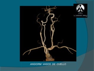 ANGIORM VASOS DE CUELLO
 