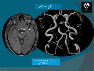 ARM 3T




ANGIO RM 3DTOF
  3 TESLA
 