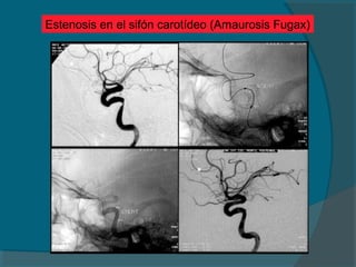 Estenosis en el sifón carotídeo (Amaurosis Fugax)
 
