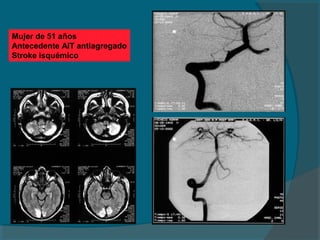 Mujer de 51 años
Antecedente AIT antiagregado
Stroke isquémico
 