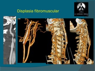 Displasia fibromuscular
 