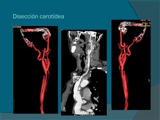 Disección carotídea
 
