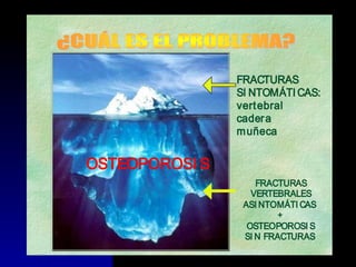 Introducción
OSTEOPOROSI S
FRACTURAS
SI NTOMÁTI CAS:
vertebral
cadera
muñeca
FRACTURAS
VERTEBRALES
ASI NTOMÁTI CAS
+
OSTEOPOROSI S
SI N FRACTURAS
 
