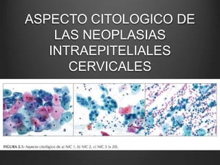 ASPECTO CITOLOGICO DE
LAS NEOPLASIAS
INTRAEPITELIALES
CERVICALES
 