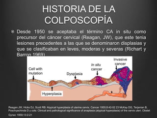 HISTORIA DE LA
COLPOSCOPÍA
Desde 1950 se aceptaba el término CA in situ como
precursor del cáncer cervical (Reagan, JW), que este tenia
lesiones precedentes a las que se denominaron displasias y
que se clasificaban en leves, moderas y severas (Richart y
Barron 1969)
Reagan JW, Hicks DJ, Scott RB: Atypical hyperplasia of uterine cervix. Cancer 1955;8:42-52 23 McKay DG, Terjanian B,
Poschyachinda D y cols: Clinical and pathological significance of anaplasia (atypical hyperplasia) of the cervix uteri. Obstet
Gynec 1959;13:2-21
 