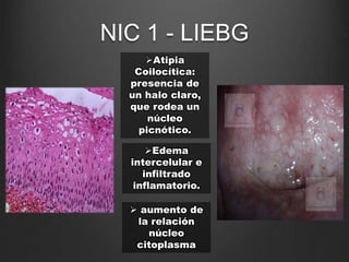 Atipia
Coilocítica:
presencia de
un halo claro,
que rodea un
núcleo
picnótico.
Edema
intercelular e
infiltrado
inflamatorio.
 aumento de
la relación
núcleo
citoplasma
NIC 1 - LIEBG
 