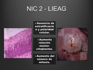 Ausencia de
estratificació
n y polaridad
celular.
Aumenta
relación
núcleo-
citoplasma.
Aumento del
número de
mitosis.
NIC 2 - LIEAG
 