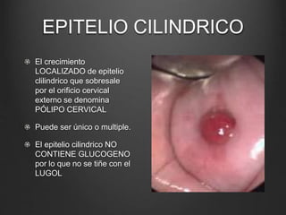EPITELIO CILINDRICO
El crecimiento
LOCALIZADO de epitelio
clilindrico que sobresale
por el orificio cervical
externo se denomina
PÓLIPO CERVICAL
Puede ser único o multiple.
El epitelio cilindrico NO
CONTIENE GLUCOGENO
por lo que no se tiñe con el
LUGOL
 