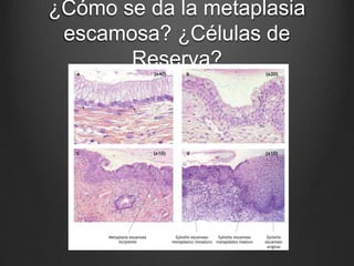 ¿Cómo se da la metaplasia
escamosa? ¿Células de
Reserva?
 