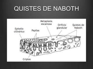 QUISTES DE NABOTH
 