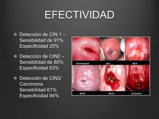 EFECTIVIDAD
Detección de CIN 1 –
Sensibilidad de 91%
Especificidad 25%
Detección de CIN2 –
Sensibilidad de 80%
Especificidad 63%
Detección de CIN3/
Carcinoma
Sensibilidad 61%
Especificidad 94%
 