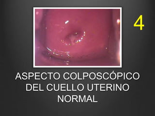 ASPECTO COLPOSCÓPICO
DEL CUELLO UTERINO
NORMAL
4
 