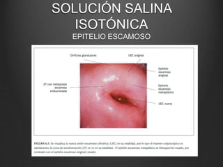 SOLUCIÓN SALINA
ISOTÓNICA
EPITELIO ESCAMOSO
 