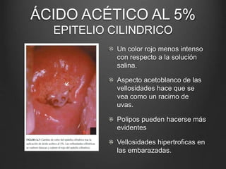 ÁCIDO ACÉTICO AL 5%
EPITELIO CILINDRICO
Un color rojo menos intenso
con respecto a la solución
salina.
Aspecto acetoblanco de las
vellosidades hace que se
vea como un racimo de
uvas.
Polipos pueden hacerse más
evidentes
Vellosidades hipertroficas en
las embarazadas.
 