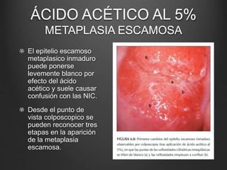 ÁCIDO ACÉTICO AL 5%
METAPLASIA ESCAMOSA
El epitelio escamoso
metaplasico inmaduro
puede ponerse
levemente blanco por
efecto del ácido
acético y suele causar
confusión con las NIC.
Desde el punto de
vista colposcopico se
pueden reconocer tres
etapas en la aparición
de la metaplasia
escamosa.
 