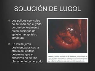 SOLUCIÓN DE LUGOL
Los polipos cervicales
no se tiñen con el yodo
porque generalmente
estan cubiertos de
epitelio metaplásico
inmaduro
En las mujeres
postmenopausicas la
atrofia del epitelio
determina que el
exocérvix no se tiña
plenamente con el yodo
 