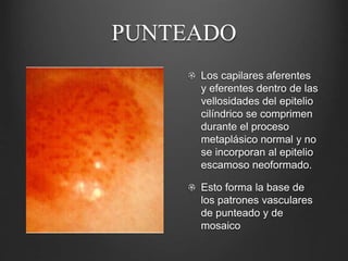 PUNTEADO
Los capilares aferentes
y eferentes dentro de las
vellosidades del epitelio
cilíndrico se comprimen
durante el proceso
metaplásico normal y no
se incorporan al epitelio
escamoso neoformado.
Esto forma la base de
los patrones vasculares
de punteado y de
mosaico
 