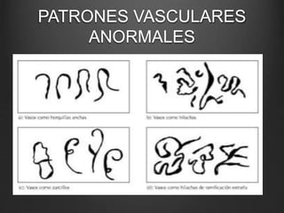 PATRONES VASCULARES
ANORMALES
 