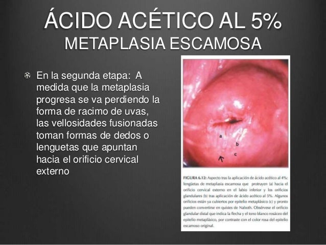 Principios básicos de Colposcopía