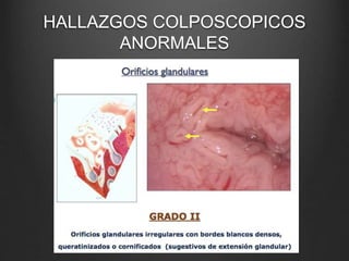 HALLAZGOS COLPOSCOPICOS
ANORMALES
 