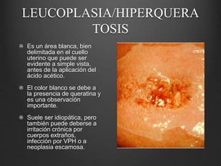 LEUCOPLASIA/HIPERQUERA
TOSIS
Es un área blanca, bien
delimitada en el cuello
uterino que puede ser
evidente a simple vista,
antes de la aplicación del
ácido acético.
El color blanco se debe a
la presencia de queratina y
es una observación
importante.
Suele ser idiopática, pero
también puede deberse a
irritación crónica por
cuerpos extraños,
infección por VPH o a
neoplasia escamosa.
 