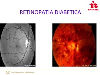 RETINOPATIA DIABETICA
 