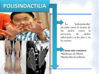 POLISINDACTILIA

                      La       "polisindactilia"
                  describe tanto la fusión de
                  los dedos como la
                  presencia      de     dedos
                  adicionales en los pies y en
                  las manos


                    Causas más comunes:
                  •Síndrome de Down
                  •Sindactilia hereditaria
 