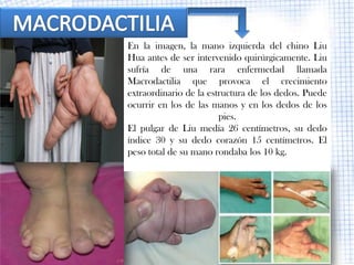 En la imagen, la mano izquierda del chino Liu
Hua antes de ser intervenido quirúrgicamente. Liu
sufría de una rara enfermedad llamada
Macrodactilia que provoca el crecimiento
extraordinario de la estructura de los dedos. Puede
ocurrir en los de las manos y en los dedos de los
                        pies.
El pulgar de Liu medía 26 centímetros, su dedo
índice 30 y su dedo corazón 15 centímetros. El
peso total de su mano rondaba los 10 kg.
 