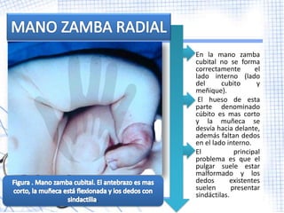  En la mano zamba
      cubital no se forma
      correctamente        el
      lado interno (lado
      del      cubito       y
      meñique).
     El hueso de esta
      parte denominado
      cúbito es mas corto
      y la muñeca se
      desvía hacia delante,
      además faltan dedos
      en el lado interno.
     El            principal
      problema es que el
      pulgar suele estar
      malformado y los
      dedos       existentes
      suelen       presentar
      sindáctilas.
.
 