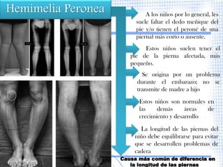 Hemimelia Peronea            A los niños por lo general, les
                         suele faltar el dedo meñique del
                         pie y/o tienen el peroné de una
                         pierna) más corto o ausente.
                            Estos niños suelen tener el
                       pie de la pierna afectada, más
                       pequeño.
                           Se origina por un problema
                         durante el embarazo; no se
                         transmite de madre a hijo
                          Estos niños son normales en
                          las    demás      áreas  de
                          crecimiento y desarrollo

                          La longitud de las piernas del
                        niño debe equilibrarse para evitar
                        que se desarrollen problemas de
                        cadera
                    Causa más común de diferencia en
                       la longitud de las piernas
 