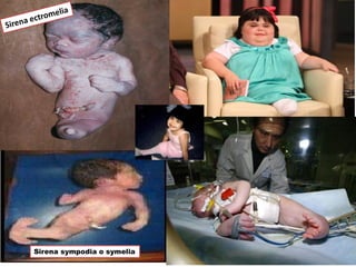 Sirena sympodia o symelia
 