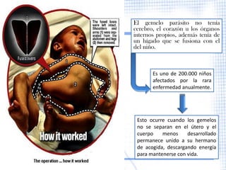 El gemelo parásito no tenía
cerebro, el corazón u los órganos
internos propios, además tenía de
un hígado que se fusiona con el
del niño.



       Es uno de 200.000 niños
       afectados por la rara
       enfermedad anualmente.




 Esto ocurre cuando los gemelos
 no se separan en el útero y el
 cuerpo    menos     desarrollado
 permanece unido a su hermano
 de acogida, descargando energía
 para mantenerse con vida.
 