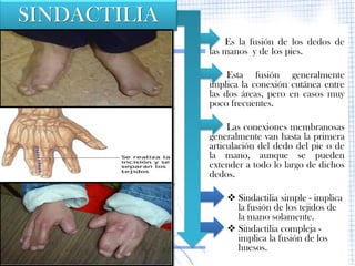SINDACTILIA
                  Es la fusión de los dedos de
              las manos y de los pies.

                   Esta fusión generalmente
              implica la conexión cutánea entre
              las dos áreas, pero en casos muy
              poco frecuentes.

                   Las conexiones membranosas
              generalmente van hasta la primera
              articulación del dedo del pie o de
              la mano, aunque se pueden
              extender a todo lo largo de dichos
              dedos.

                   Sindactilia simple - implica
                    la fusión de los tejidos de
                    la mano solamente.
                   Sindactilia compleja -
                    implica la fusión de los
                    huesos.
 