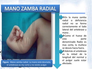 En la mano zamba
                                                     radial o deficiencia
                                                     radial no se forma
                                                     correctamente el lado
                                                     lateral del antebrazo y
                                                     mano .
                                                     Como el hueso de
                                                     esta              parte
                                                     denominado Radio es
                                                     mas corto, la muñeca
                                                     se desvía hacia fuera.
                                                     Además el antebrazo
                                                     es la mitad de la
                                                     longitud del normal y
                                                     el pulgar suele estar
Figura . Mano zamba radial. La mano está desviada,
                                                     afectado.
    el antebrazo es my corto y no existe pulgar.
 