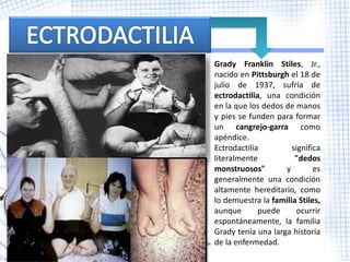 Grady Franklin Stiles, Jr.,
nacido en Pittsburgh el 18 de
julio de 1937, sufría de
ectrodactilia, una condición
en la que los dedos de manos
y pies se funden para formar
un cangrejo-garra como
apéndice.
Ectrodactilia         significa
literalmente           "dedos
monstruosos"        y        es
generalmente una condición
altamente hereditario, como
lo demuestra la familia Stiles,
aunque       puede      ocurrir
espontáneamente, la familia
Grady tenía una larga historia
de la enfermedad.
 