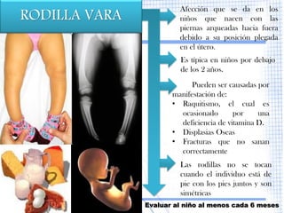 RODILLA VARA
                        Afección que se da en los
                        niños que nacen con las
                        piernas arqueadas hacia fuera
                        debido a su posición plegada
                        en el útero.
                        Es típica en niños por debajo
                        de los 2 años.
                            Pueden ser causadas por
                      manifestación de:
                      • Raquitismo, el cual es
                        ocasionado       por    una
                        deficiencia de vitamina D.
                      • Displasias Oseas
                      • Fracturas que no sanan
                        correctamente
                        Las rodillas no se tocan
                        cuando el individuo está de
                        pie con los pies juntos y son
                        simétricas
               Evaluar al niño al menos cada 6 meses
 