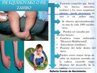 PIE EQUINOVARO O PIE          Trastorno congénito que Afecta
       ZAMBO                  a   los   huesos,     músculos,
                              tendones y los vasos sanguíneos
                              además, puede presentarse en
                              uno o en ambos pies.
                                 Se observa aproximadamente
                                 en uno de cada 1000 nacidos
                                 vivos.
                                  Pueden ser causadas por
                            muchos factores
                            • Genéticos como ambientales
                               “Herencia Multifactorial".
                            • Antecedentes familiares.
                            • Posición del bebé dentro del
                               útero.
                              Pueden correr mayor riesgo de
                              sufrir un trastorno asociado en
                              la cadera, conocido como
                              Displasia del desarrollo de la
                              cadera.
                       Defecto Común de Nacimiento.
 