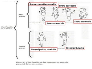 Sirena sympodia o symelia
                              Sirena ectropodia




                                             Sirena ectromelia
                 Sirena monopodia




                                    Sirena lambdoidea
 Sirena dipodia o simeloide
 