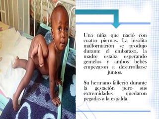 Una niña que nació con
cuatro piernas. La insólita
malformación se produjo
durante el embarazo, la
madre estaba esperando
gemelos y ambos bebés
empezaron a desarrollarse
          juntos.
Su hermano falleció durante
la gestación pero sus
extremidades       quedaron
pegadas a la espalda.
 