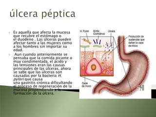 HiperclorhidriasEs un incremento de ácido gástrico secretado por unidad de tiempo.Se debe al aumento en la producción de ácido por las células parietales gástricas.Esto ocurre en el síndrome de Zollinger-Ellison, que son tumores del páncreas que segregan gastrina y que a su vez también ayudan a producir úlceras.