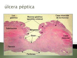 úlcera pépticaalgunas úlceras son causadas por el uso prolongado de antiinflamatorios no esteroideos (AINE), como la aspirina (ácido acetilsalicílico) y el ibuprofeno.Imagen endoscópica de úlcera péptica profunda en el antro gástrico