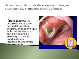 úlcera péptica La úlcera se distingue de la erosión (que solamente afecta a la mucosa) en que traspasa la capa muscular situada bajo la mucosa  y profundiza, durante su evolución, en todo el grosor de la pared gástrica o duodenal.en ocasiones llega a provocar la perforación de dicha pared. La presencia de la úlcera pone en marcha un proceso de cicatrización, con formación de tejido fibroso (fibrosis) a su alrededor, que resulta fallido sin el tratamiento apropiado.
