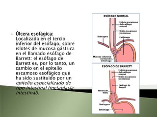 Dependiendo de su localización anatómica, se distinguen las siguientes úlceras pépticas: Úlcera duodenal: Se desarrolla en la parte inicial del intestino delgado, el duodeno, que es la que comienza a partir del píloro del estómago. La úlcera duodenal es la localización anatómica más frecuente.