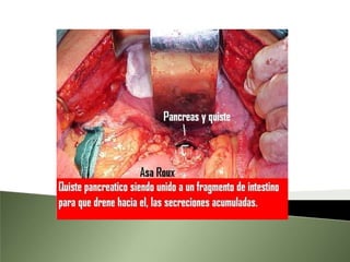 Tapones de proteína eosinofila dentro de la luces de los conductos