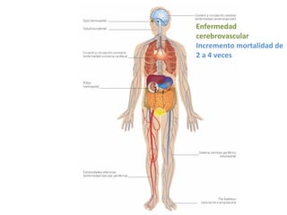 Enfermedad
cerebrovascular
Incremento mortalidad de
2 a 4 veces
 