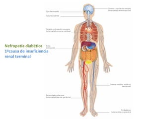 Nefropatía diabética
1ªcausa de insuficiencia
renal terminal
 